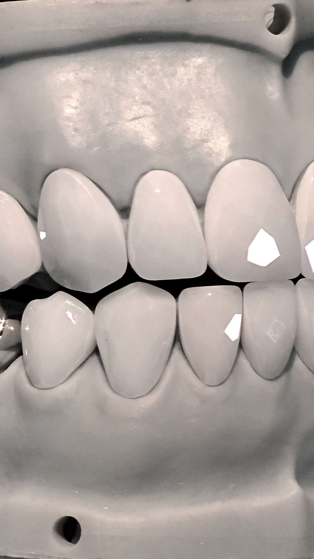 JDWR-V1-CUSTOM-DENTAL-VENEERS