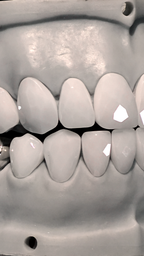 JDWR-V1-CUSTOM-DENTAL-VENEERS