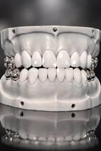 JDWR-V1-CUSTOM-DENTAL-VENEERS