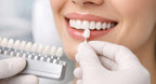 JDWR-V1-CUSTOM-DENTAL-VENEERS